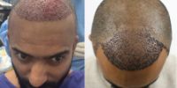 HT_Hair-Transplant-3