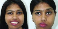 Orthognathic Surgery in Major Congenital Syndromes