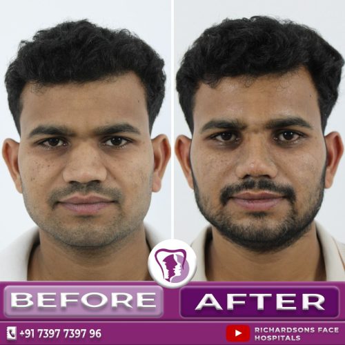 Male Rhinoplasty