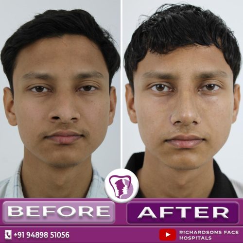 Male Nose job Before and After