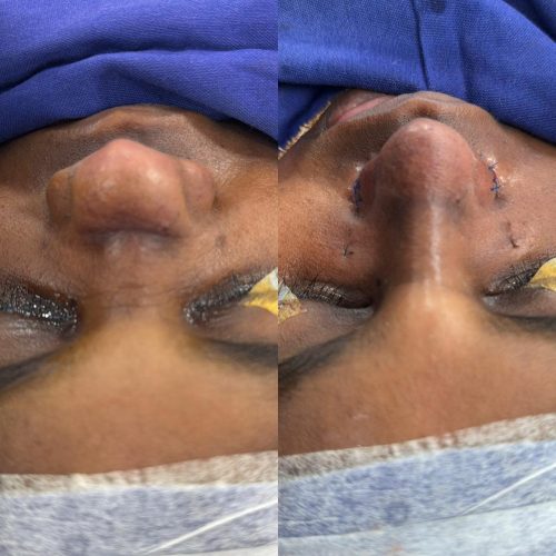 Nosejob Augmentative Rhinoplasty
