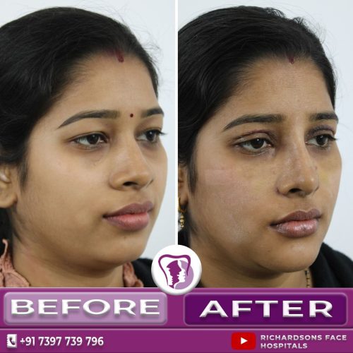 Nosejob with Genioplasty Female Face Side Profile before & after