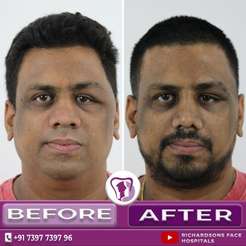 Orbital tumour and craniofacial surgery