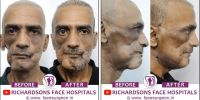 Post-Cancer Facial Reconstruction
