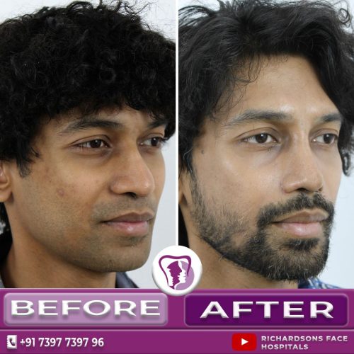 Revision Nose Re-contouring Surgery