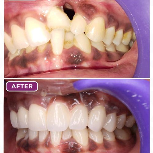 Smile Designing