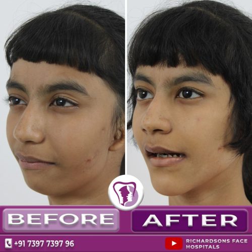 TMJ joint Reconstruction with Orthognathic Surgery 
