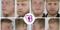 Beard Transplant Surgery